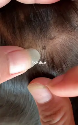 #tiktokindia_ #omg #lice #removalice 