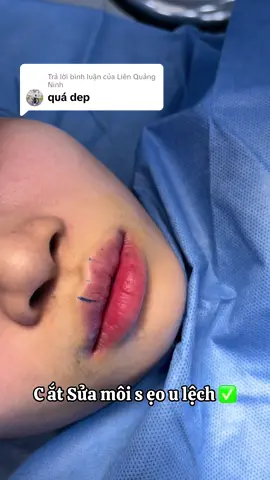 Trả lời @Liên Quảng Ninh lên dáng môi sửa sẹo lệch về phom môi tự nhiên tươi tắn nha #catmoi #catmoidep #catmoitraitim #catmoitunhien 