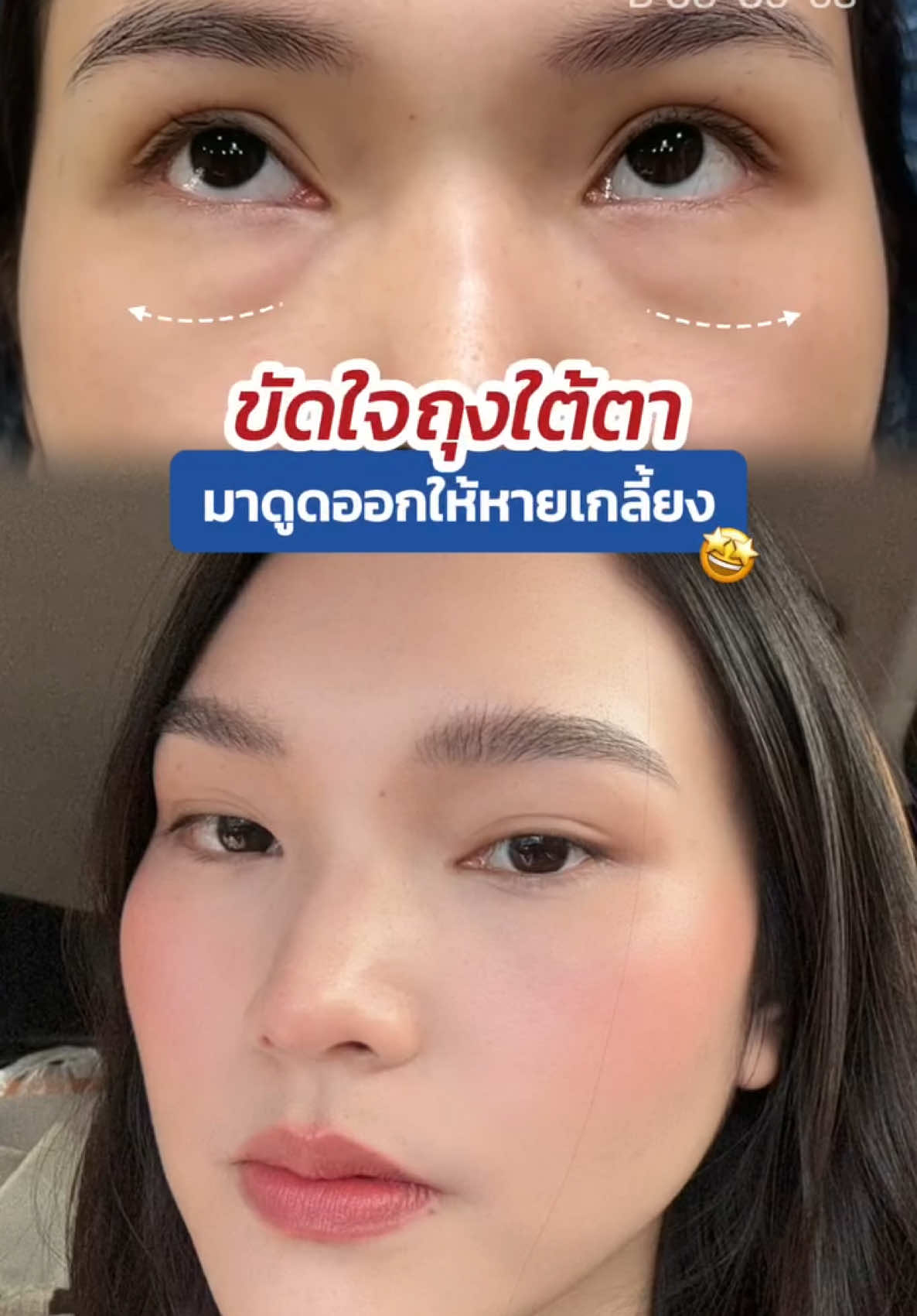 ขัดใจ #ถุงใต้ตา เลยต้องมาดูดออกให้หาย 🤩 #skyclinic #รีวิวกำจัดถุงใต้ตา #จักษุแพทย์ #ทำตาที่ไหนดี #สกายคลินิก #babylock 