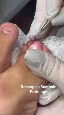 #podologos#podologas#podologia#podologiacomamor#podologiacientifica#onicocriptose#podologiaporamor#pederisco#anatomiadaunha#fungos#onicomicose#podopediatria#trauma#unhasencravadas#podogeriatria#podologia.satisfatório.online#oiunhaslindas#ingrohntoenail#ingrohn#unhasbrasil#unhasprontas#granulomo#saudedospes#unhas#unhasdospes#formacaoempodologia#unhasepodologia#unhassendotratadas#unhas 