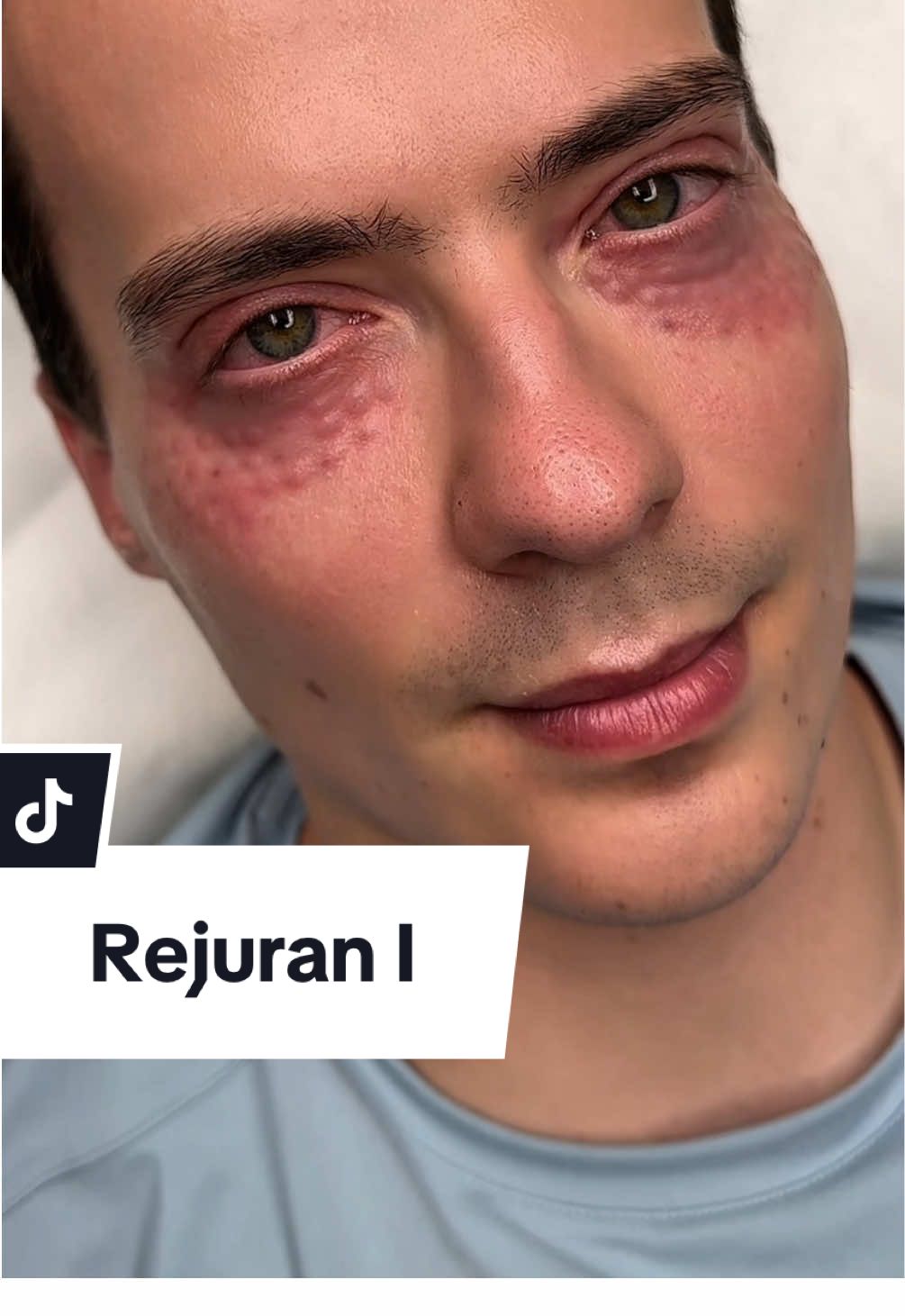 Doing Rejuran I on my husband - session nr 2. We will do one more session and show the final effect soon 💉 #rejuran #rejurani #koreanskincare 