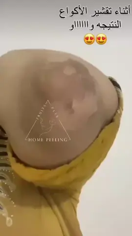 النتيجة تخبلللل😍💗💗💗 البكج الثلاثي الاقوى مقشر احماض الفواكة مقشر بارد بديل عن المراكز  وشغله يجننننن 😍✨ يمنحج نعومة وبشرة صافية وخالية من التصبغات  #اكسبلور_فولو #لايكات #تفاعل #بغداد #مقشر_الاحماض #مقشر_كيميائي #مقشر_أحماض_الفواكة #مقشر_كيمائي 