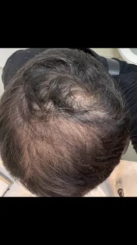 #tratamentocapilar #dutasterida #minoxidil #adforte #calvicemasculina 