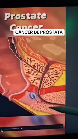 Câncer de próstata