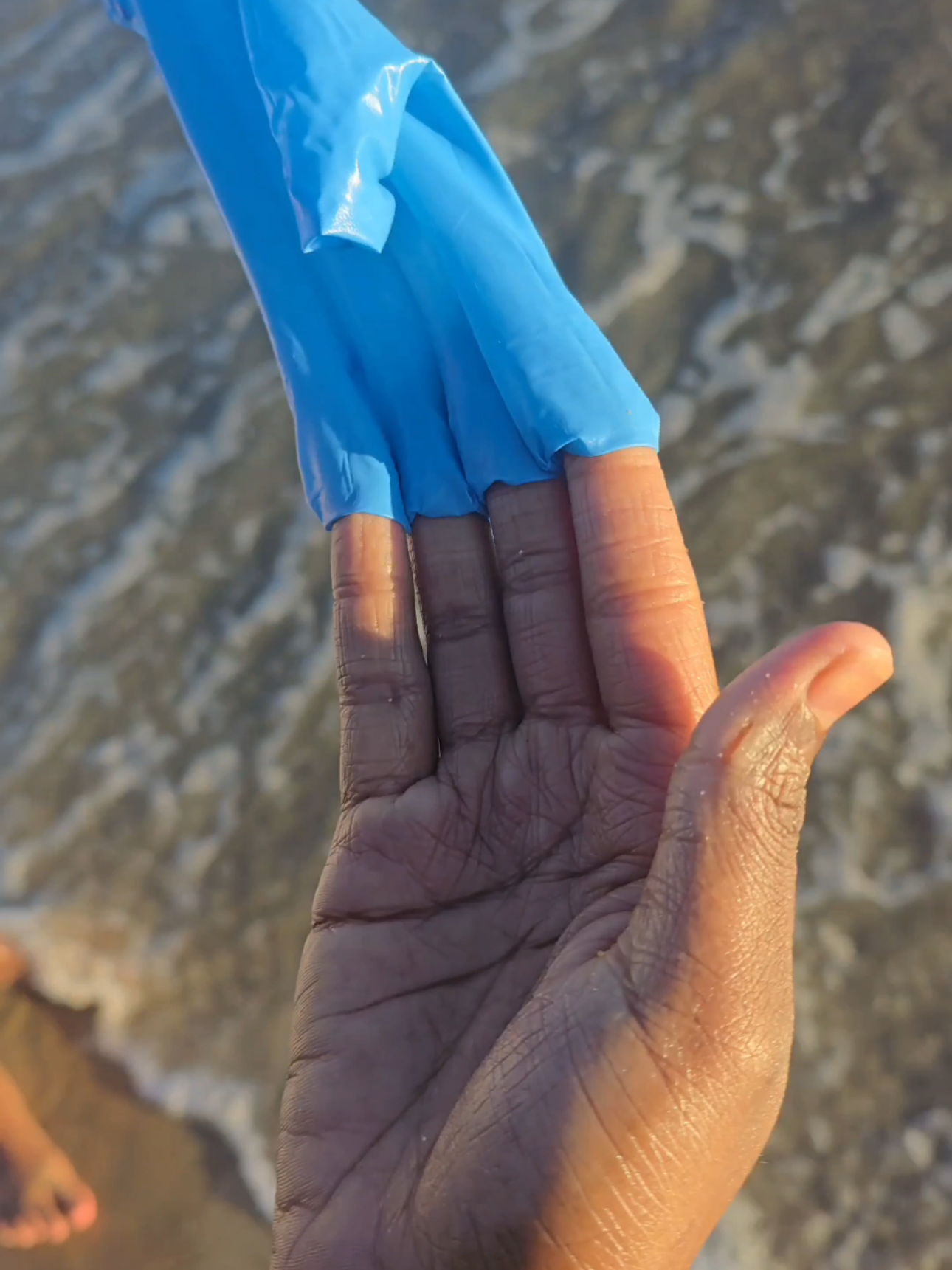 What my hand eczema looks like after wearing a glove and washing it in the ocean. Apparently the ocean heals eczema #dermatologist #eczema #psoriasis #eczemaawareness #skincondition #handeczema #eczemarelief #ocean 