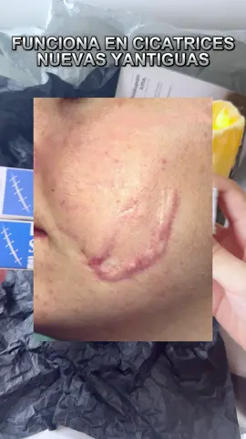 #fentysuperbrandday #bodycareproducts #skincare #scarremover #acen #burns #scars #fyp #burnscars #Tatcha 