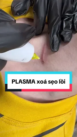 Xóa sẹo lồi với phương phápPlasma#xuhuong2025🍀🍀 #kim7magnum #phunmoitanvien #phunxamthammychuyennghiep #phunmay #sơihairtroke #plasmafibroblast 