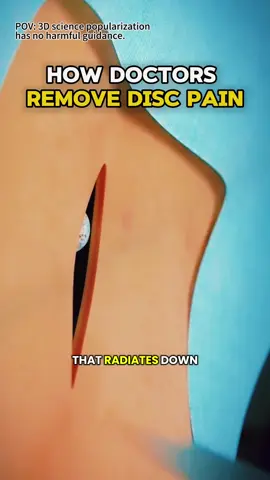 Removing Herniated Disc Surgery 3D Animation #soinalcordinjury #spinesurgery #spinalcordsurgery #herniateddisc #herniateddiscbackpain #herniateddisk #herniateddiscs #herniateddiscfix #medical3danimation #3dmedicalanimation