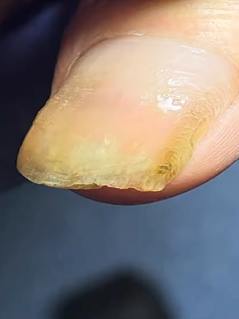 Cut Extra Long Nails Easily #naildesigns #pedicure #ingrownnail #nailtutorial #fungusnailstreatment #ingrowntoenail #viraltiktok #nailsartvideos #fungusnails #nailart #fungus #viralvideo #viral #修脚 #trendingindia #nails #nailpolish #trend #toenail #nail #laykhoemongchan❤ #laykhoemongtay #fyp #fypシ゚viral #fyppppppppppppppppppppppp