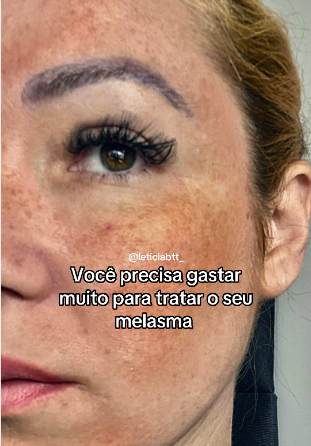 Melhor CLAREADOR que poderia ter usado!  Amiga deixei ele na sacolinha laranja em cima do meu nome aqui nesse vídeo, só clicar que vai abrir o site oficial dele, é o ORIGINAL!  #skincare #manchasnorosto #melasma #despigmentação 
