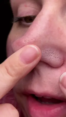 My pores? Cleared. My blackheads? Evicted. This Dr. Melaxin Peel Shot pulls out the gunk like a magnet—I didn’t know I needed this until I saw what came out 😳 If you’re addicted to watching your skin purge, just tap that cart. It’s so gross… but so good. #peelshot #drmelaxin #porecleanser #blackheadremoval #skincaretok #facialdetox #tiktokskincare