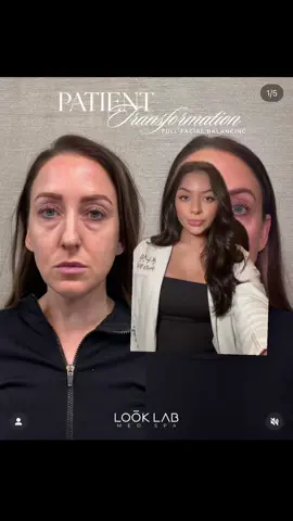 Facial balancing is all about treating the face as a whole—not just one feature ✨ @Erin | AZ Aesthetic Injector  🗓️ Love your look—Book your appointment today at LookLab.com or call 833.999.5665 (LOOK) #MedSpa #Botox #Filler #FacialBalancing 