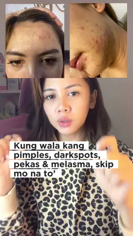 Kung makinis na ang face mo, skip ko na to #azelaic #azelaicacidserum #azelaicacid #acne #acnetreatment #acneproneskin #pimples 