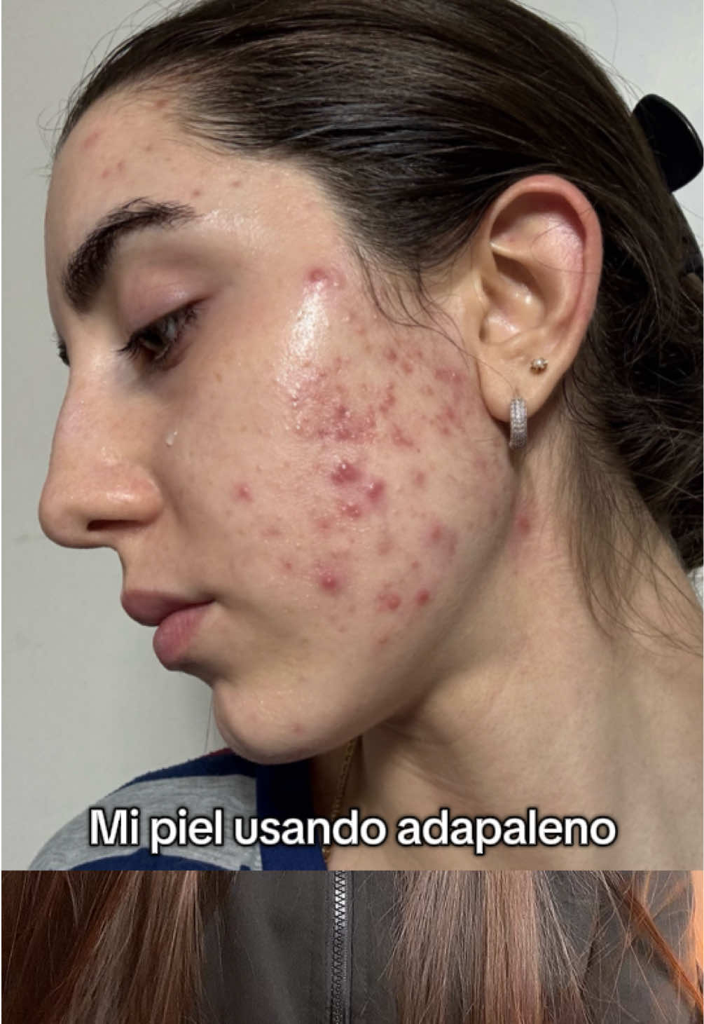 Mi piel en el proceso del ADAPALENO 💙  #adapalene #adapaleno #acne #comedones #skin #piel #skincare #fyp #viral  Gracias @Avène por crear el Cicalfate 