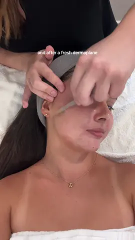 For my acne girls 🫶🏼 check out @ ransombeauty on IG if you’re in the Tampa Bay Area! #skincare #facial #esthetician #acneproneskin #acne #skincareroutine 
