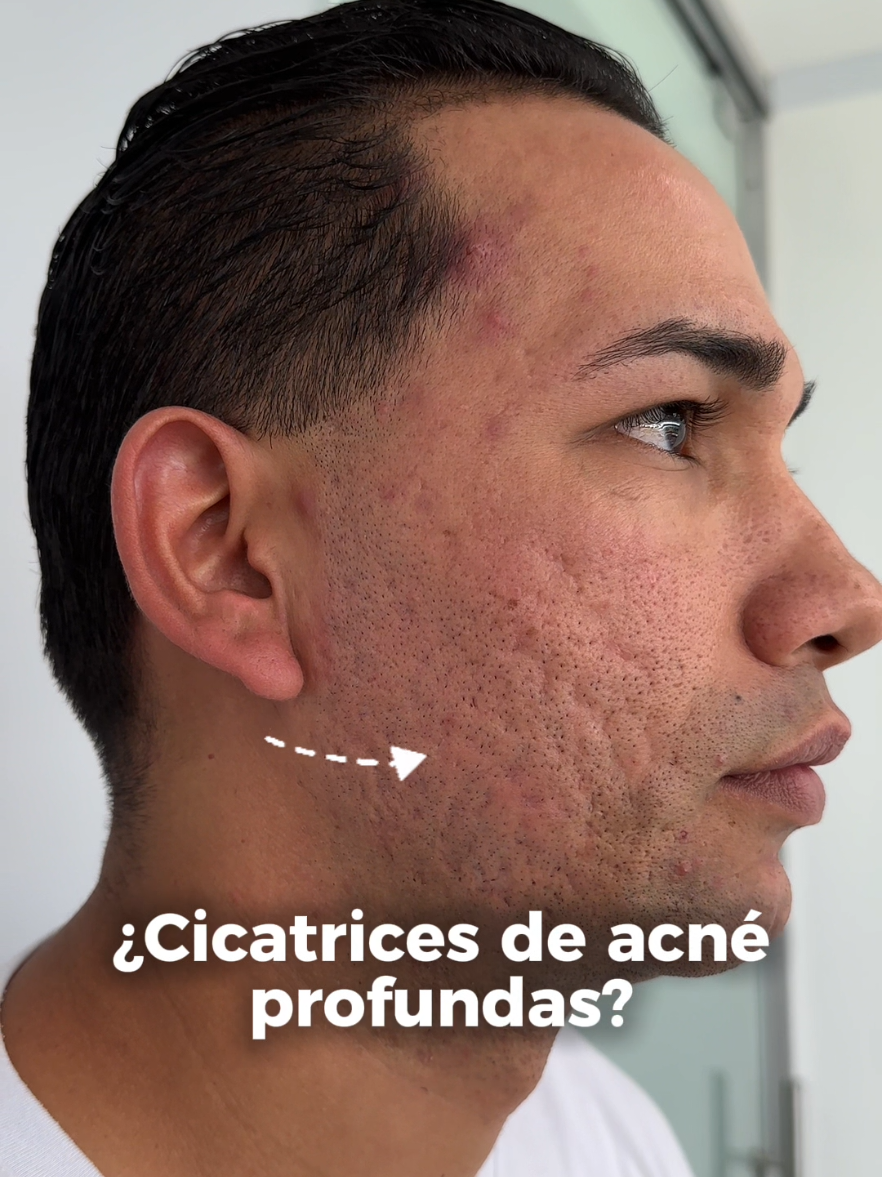 ✨ ¿Cicatrices? Aquí te contamos lo que sí funciona 👇🏻 Este es el resultado de 5 sesiones combinadas de Láser CO2 fraccionado, Subcisión y Exosomas: una estrategia avanzada para tratar cicatrices profundas y textura irregular ✨ Cada técnica cumple un propósito: 🔸 El Láser CO2 mejora la textura y estimula el colágeno desde las capas profundas 🔸 La Subcisión libera las adherencias que causan hundimientos en la piel 🔸 Los Exosomas potencian la regeneración celular y aceleran la recuperación 💡 Resultado: una piel más lisa, con tono uniforme y cicatrices visiblemente suavizadas ✨La constancia marca la diferencia ✨ Si quieres saber si este tratamiento es para ti,escríbenos 📩 #LáserCO2 #Subcisión #Exosomas #CicatricesDeAcné #medellin #medicinaestetica #DraBeauty #fyp 
