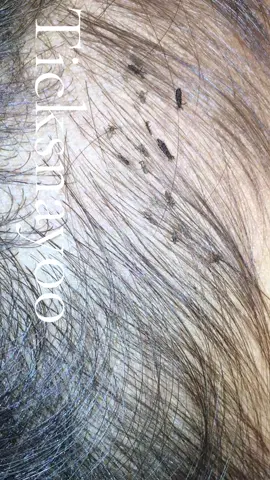 Remove lice #omg😱😱😱 #lice #lice😰😰😰 #tripofobia😮😥 #😰😨😭 #liceremoval #😂😂😂 #removelice 