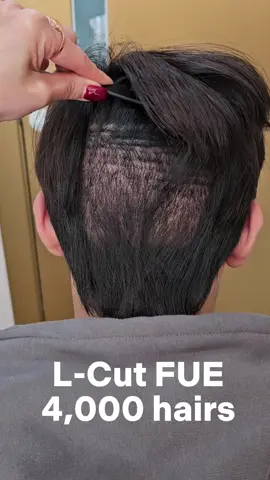 Donor area after 4,000 hairs L-cut FUE and 2 weeks post-op appearance #HairTransplant #FUE #HairRestoration #HairTransplantBeforeAfter #HairTransplantJourney #HairTransplantResults #FUEHairTransplant #HairTransplantClinic #HairLossSolution #HairLossTreatment #HairTransplantSurgery #RecedingHairline #HairGrowth #Dreamhairline