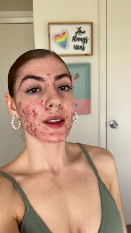 Para sentirte bonita tienes que darte atención a lo que si te gusta de ti 🪞🌷 La Ari del pasado te dice que vas a estar bien y que y que VALES MUCHO más de lo que piensas!!! Tu acné no te define ❤️‍🩹 Hace unos meses pasé por un brote súper fuerte de acné; claro que al principio me avergonze, me deprimí y me enojé, pero al final lo acepté y lo abracé!! Aprendí a quererme TAL Y COMO SOY!!! Y ahora me respeto tanto que nada ni NADIE puede hacerme sentir menos por no tener la piel 