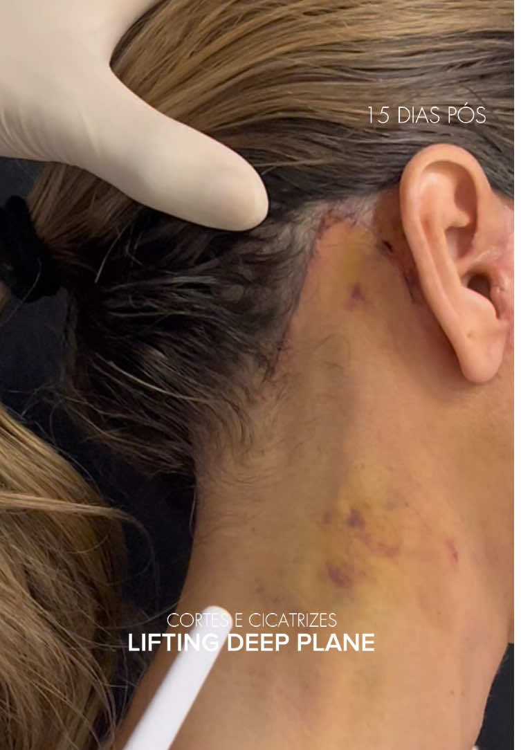 . . . . . Dr. Carlos Bucheli CRM: 5264162-6 RQE:56019 . . . #beforeandafter #nariznegroide #lifting #liftingfacial #liftingfacialsincirugia #deepplanefacelift #drcarlosbucheli #foryou #fpyシ 