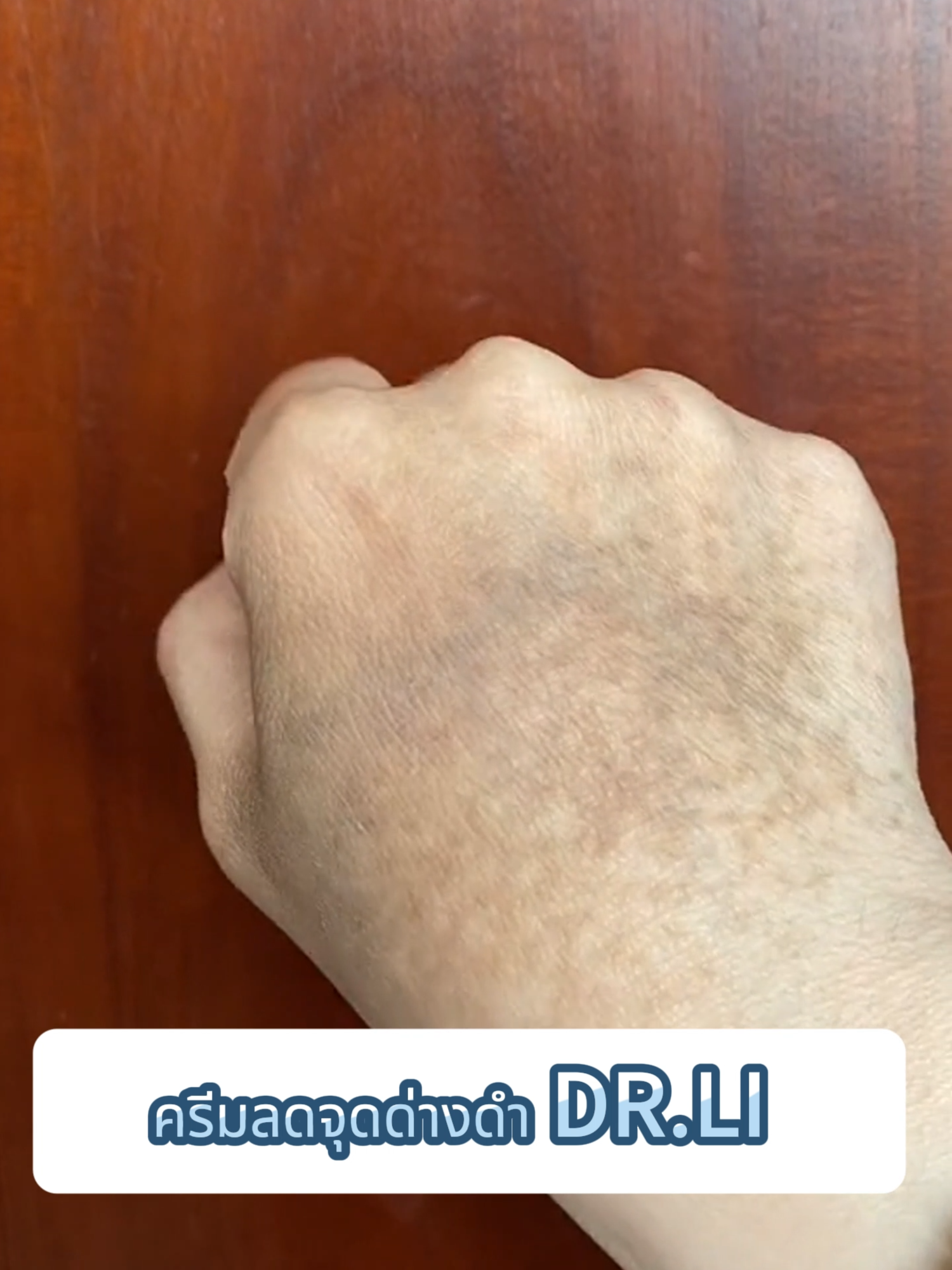 จุดด่างดำที่มือจะไม่อยู่กับคุณตลอดไป เพียงทาครีม DR.LI เป็นประจำ ช่วยลดเลือนจุดด่างดำ ฝ้าแดด รอยช้ำ บนมือได้อย่างเห็นผล