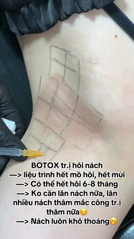 Tạm biệt Mồ hôi và mùi hôi nách chỉ sau 10’ #MinHynBeauty #botoxmohoinach #xuhuong #lamdep 