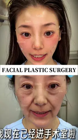 Our Korean style facial three line lift is a cosmetic technique that improves facial sagging and wrinkles through surgical or non-surgical methods. The principle mainly includes the following aspects: 1. Enhancement of SMAS layer: The SMAS layer is a layer of connective tissue between the facial skin and muscles. By enhancing the SMAS layer, facial skin can be tightened, reducing wrinkles and sagging. 2. Ligament elevation: There are many ligaments on the face that connect the facial bones and muscles. By lifting these ligaments, the facial support structure can be enhanced and sagging can be reduced. 3. Fat reset: The distribution and location of facial fat can also affect the appearance of the face. By adjusting the position and distribution of fat, facial contours and lines can be improved The surgical process takes only 20 minutes to recover, and the recovery period can last for 5-7 days Sustainable results 5-8 years #facelift #beauty #beautifyme #抗衰老 #整形 #医美 #面部提升 #变美 