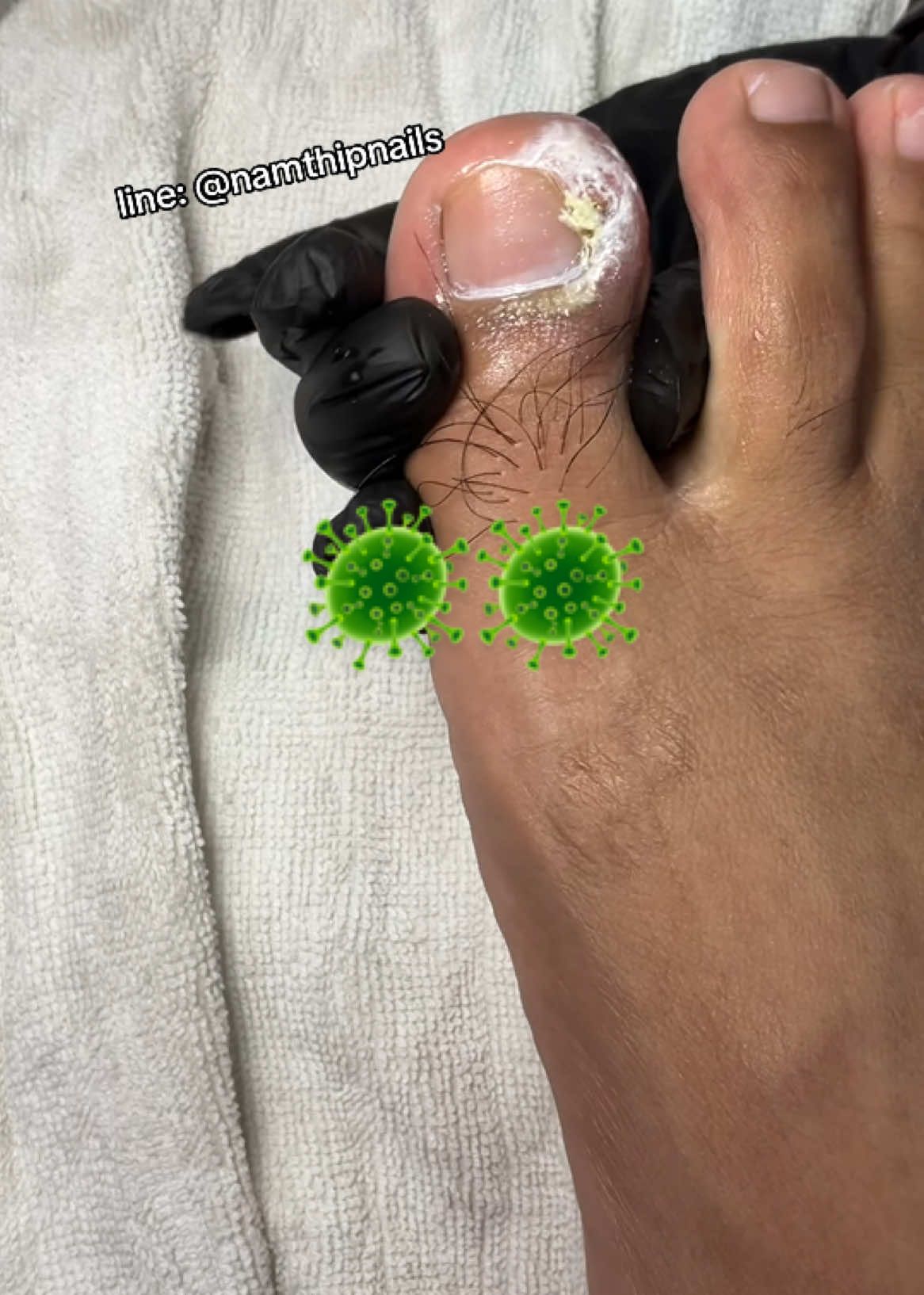 💓 #namthipnails #ตัดเล็บขบ #ตัดหนัง #ทำเล็บ #ร้านตัดเล็บขบ #ร้านตัดเล็บขบราม2 #ร้านทำเล็บ #เล็บขบ  #เล็บเชื้อรา Fb : namthipnails  Line : @namthipnails  นัมเบอร์วัน8 ตลาดม.ราม2  กทม  Map: namthipnails  https://goo.gl/maps/JmwpCKLfKwmhKGK96  ร้านเปิดทุกวัน เวลา12.00น-22.00น.