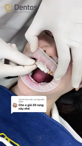 Trả lời @Nguyễn Diễm  Giá 20 răng là 30tr em nhé, đang được khuyến mãi nha e