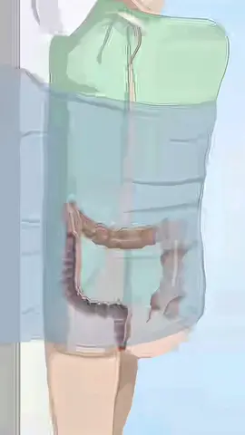 How Colon Polyps Are Removed – Life-Saving Surgery Explained! #ColonPolyps #PolypRemoval #DigestiveHealth #Colonoscopy #MedicalEducation #DoctorTok #HealthAwareness #TikTokMedicine #SurgeryExplained #PreventCancer