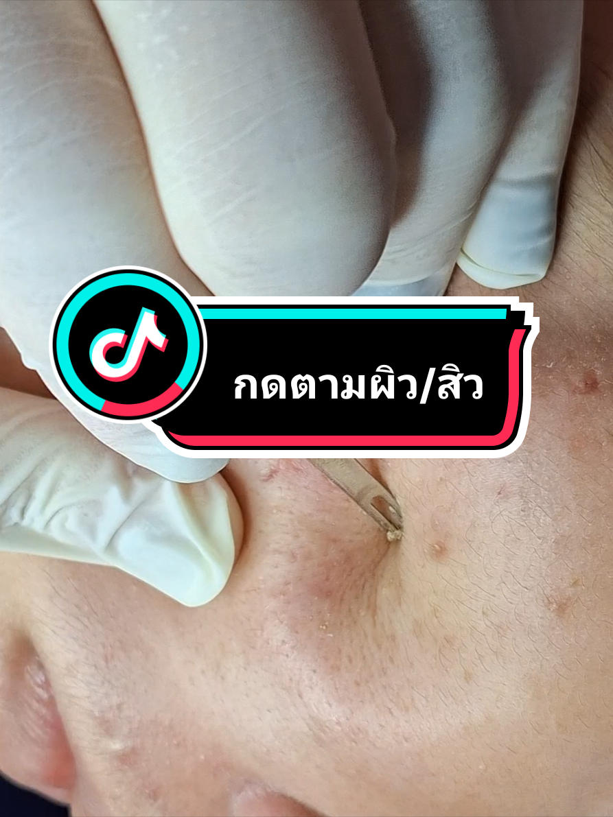 #สิวอุดตัน #สิว #กดออกหายสิว #เทคนิคพี่กุ้งกดสิว #พี่กุ้งกดสิว #กดสิว #หายสิว