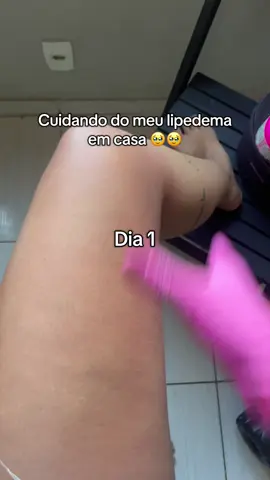 Estou fazendo tratamento de lipedema em casa com um creme e documentei a diferença em 2 meses de tratamento, notei bastante diferença na textura da pele, como sempre digo precisa fazer o tratamento certinho todos os dias ❤️❤️ #lipedema #celulite #autocuidado #flacidez 