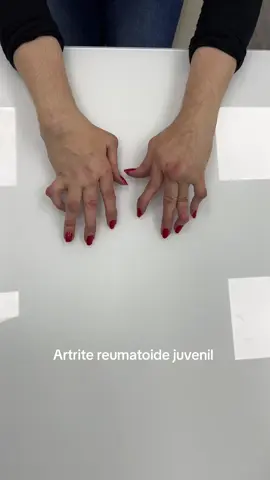 Mãos e punho artrite reumatoide com manifestação juvenil. #saude #fy #dores #qualidadedevida #rheumatoidarthritis 