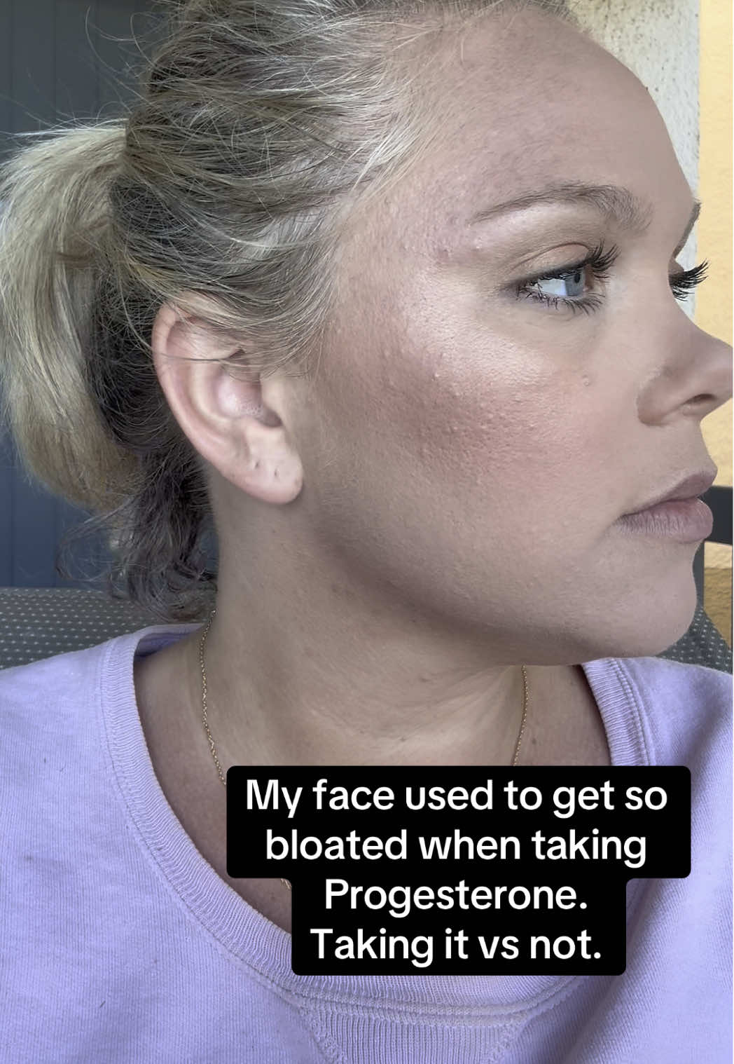 You can clearly see the difference. Why did this happen?! It literally would wear off when it was time for my next dose. #hormone #hormones #perimenopause #pcos 