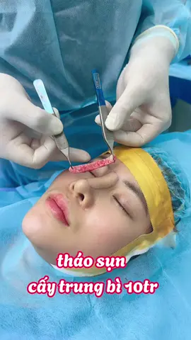 tháo sụn cấy trung bì 10tr..