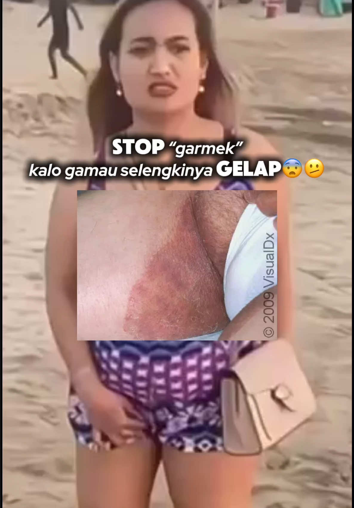Udah tahu gatal, digaruk terus sampe lecet. Trus nyalahin semesta? 😭 NO BABE! STOP GARMEK‼️ #tineacruris #slengkihitam #ruamselangkangan #selangkanganghitam #creamgatal #creamiritasi #naturalantiperspirant #ciarachamomilecream #ciaradeospray #ciaraindonesia 