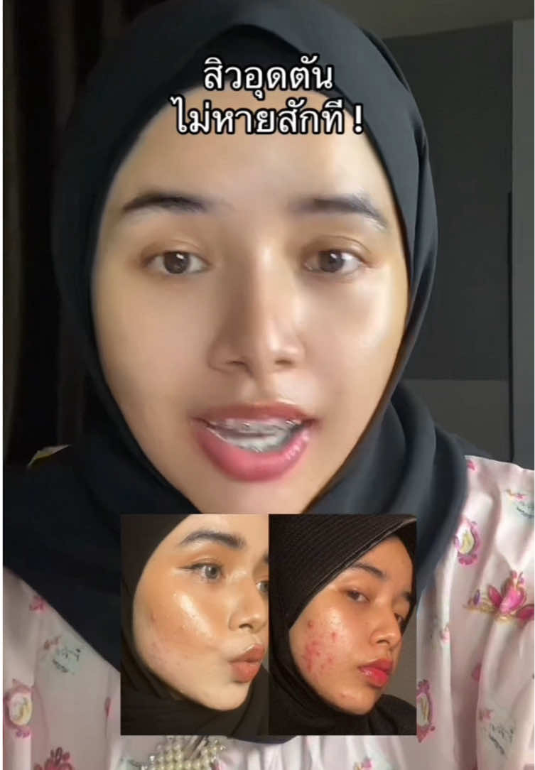 รักษากี่รอบ ก็วนลูปเดิม #เซรั่มละลายสิว #เซรั่มละลายสิวบาล์มบู #เซรั่มละลายสิวอุดตันblahmbooh #blahmboohthailand 