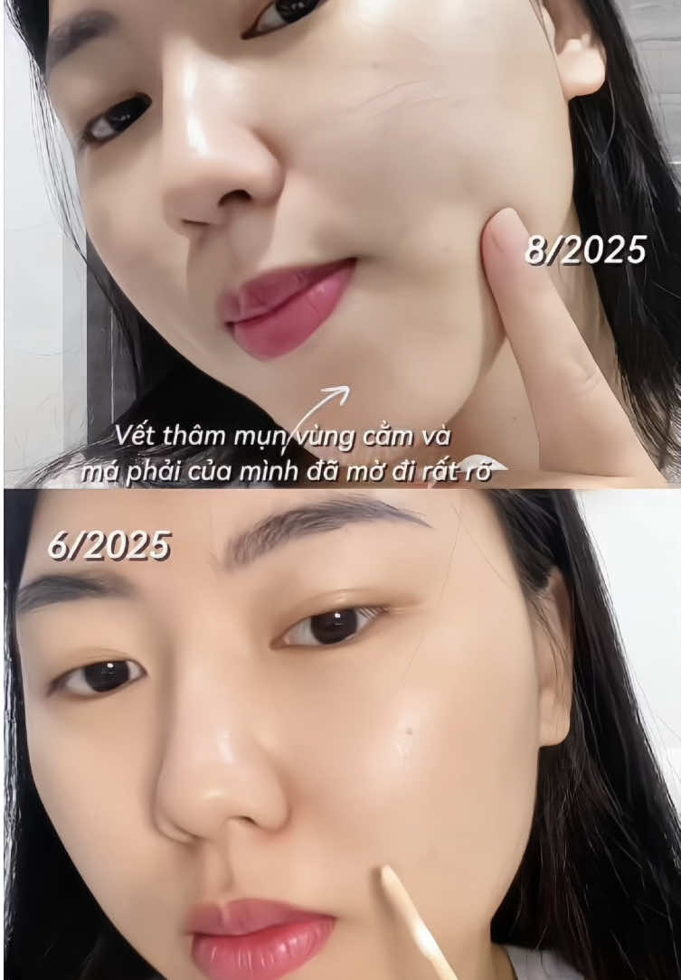 Sau 1 tháng sử dụng Melasyl, vết thâm mụn và vết thâm do xóa nốt ruồi của mình mờ đi rồi mọi người ơi ✨ rất là recommend luôn í #lorealparis #goclamdep #LearnOnTikTok #skincare #melasyl #duongsangda 