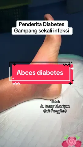 Luka infeksi kaki akibat gula darah yg tinggi terus pada pasien diabetes#donny #dokteranestesi #lakipanggilan #abces 