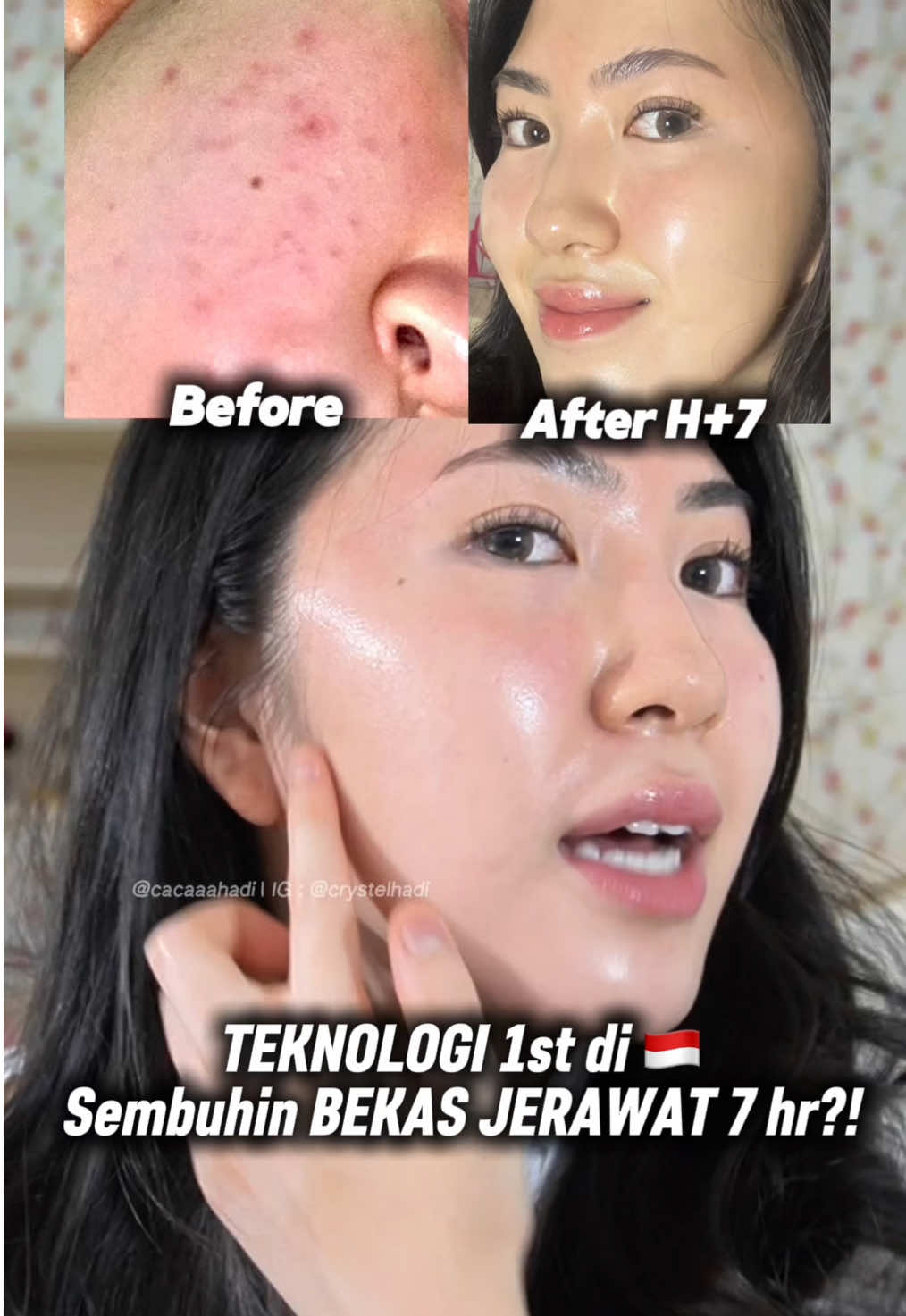 GLOWING Bekas jerawat jadi cepet bgt ilangnya pake teknologi serum terbaru ini, pantesan ditanyain orang mulu kulitnya glowing cerah bgt dikira treatment jutaan    #bekasjerawat #tipsjerawat #skincarejerawat #skincarebrightening #vitamincserum #serumvitc #acneskincareroutine #skincareroutine 