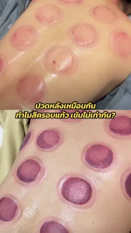 ปวดหลังเหมือนกัน ทำไมรอยครอบแก้วเข้มไม่เท่ากัน?  #ครอบแก้วบําบัด #ครอบแก้วบําบัด #cupping #cuppingtherapy #ออฟฟิศซินโดรม #ปวดเมื่อย #ปวดคอบ่าไหล่ #ปวดหลัง #ปวดหลังร้าวลงขา 
