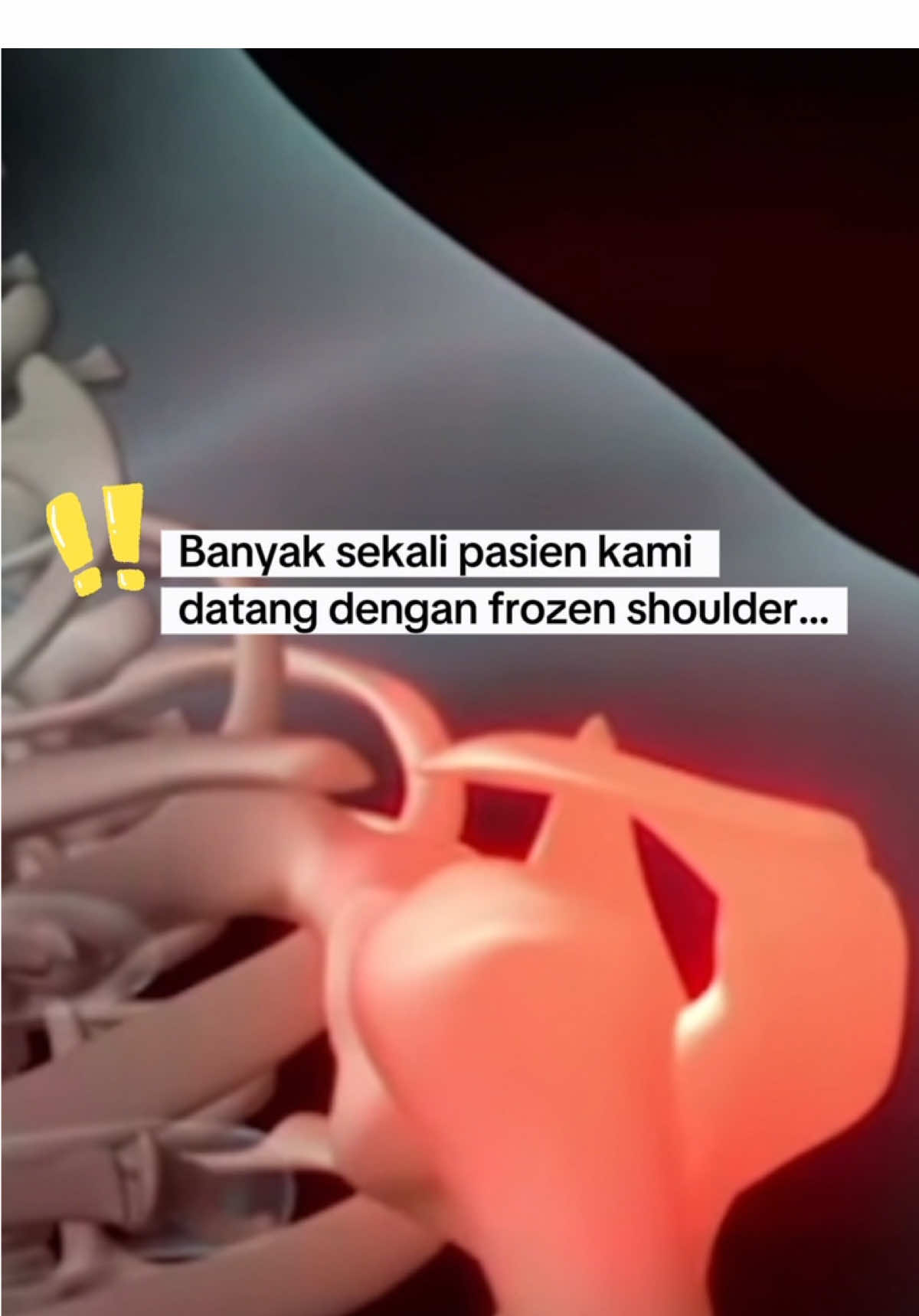 Bahu kaku dan nyeri setelah stroke? Itu bisa jadi frozen shoulder! Komplikasi ini sering terjadi kalau terapi dan gerakan tidak dilakukan sejak awal. Di GenQi Centre, kami bantu pulihkan nyeri tanpa rasa sakit. #genqi #inhalerhidrogen #terapistroke #genqicentre #drhaviza #genqimedan 