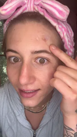 Pimple patch result !!