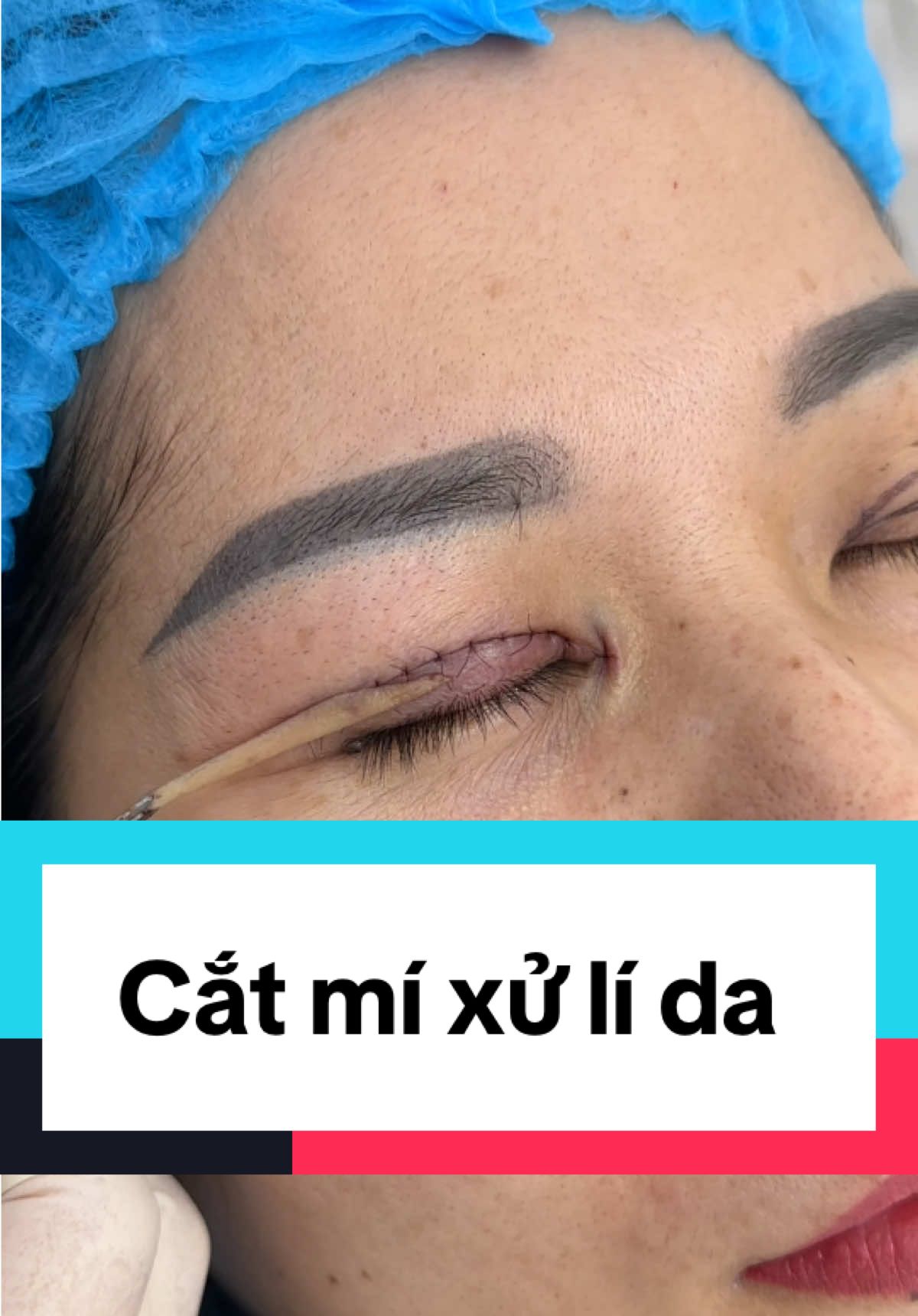 Cắt mí xử lí da chùng kết hợp mở góc mắt trong #catmi #catmidep #catmimat #mogocmat #xuhuong #ilovetiktok 