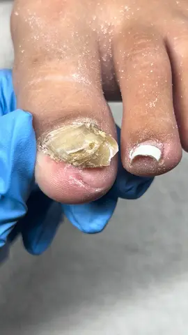 📢 Let’s Talk About Thick Toenails! If your toenails feel hard, bulky, or tough to cut – you’re not alone. Thick nails can happen for a few reasons: ✨ Fungus (the #1 cause) ✨ Past injury or pressure from shoes ✨ Aging or health conditions like diabetes or psoriasis Why it matters: 	•	Thick nails can trap fungus and bacteria 	•	They may cause pain or pressure in shoes 	•	Left untreated, they can get harder to manage 💅 Good news? I specialize in safely reducing thickness, smoothing the surface, and giving your nails a fresh, healthy look. 📆 Book your appointment today and let’s get those nails back to sleek and comfortable. #ToenailCare #NailTransformation #HealthyFeetHappyYou #ThickNailTreatment . . . . . . . . . . . . . . . . . #toenailreconstruction #chicagonailtech #reconstructivepedicure #newtoenail #nailhealth   #ToenailCare #NailTransformation #HealthyFeetHappyYou #ThickNailTreatment  #toenailcarespecialist #thicknails #SelfCare 