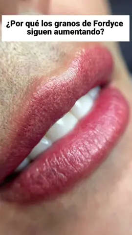 Belani reduces Fordyce stains with 5 times greater effectiveness #fordycespots #fordyce