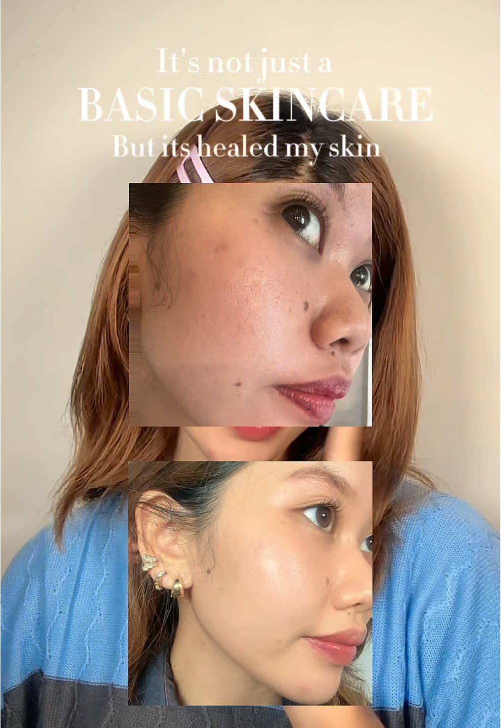Bukan sekedar basic skincare, terima kasih ya @msglow.beauty 🤗 #acnebooster #msglowskincare #msglowbeauty #acnetreatment #blemishfree #basicskincareroutine 