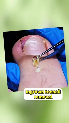 Ingrown toenail removal #ingrowntoenail #ingrownnailremoval #toenailremoval #viralvideo #podologia #pedicure #foryou 