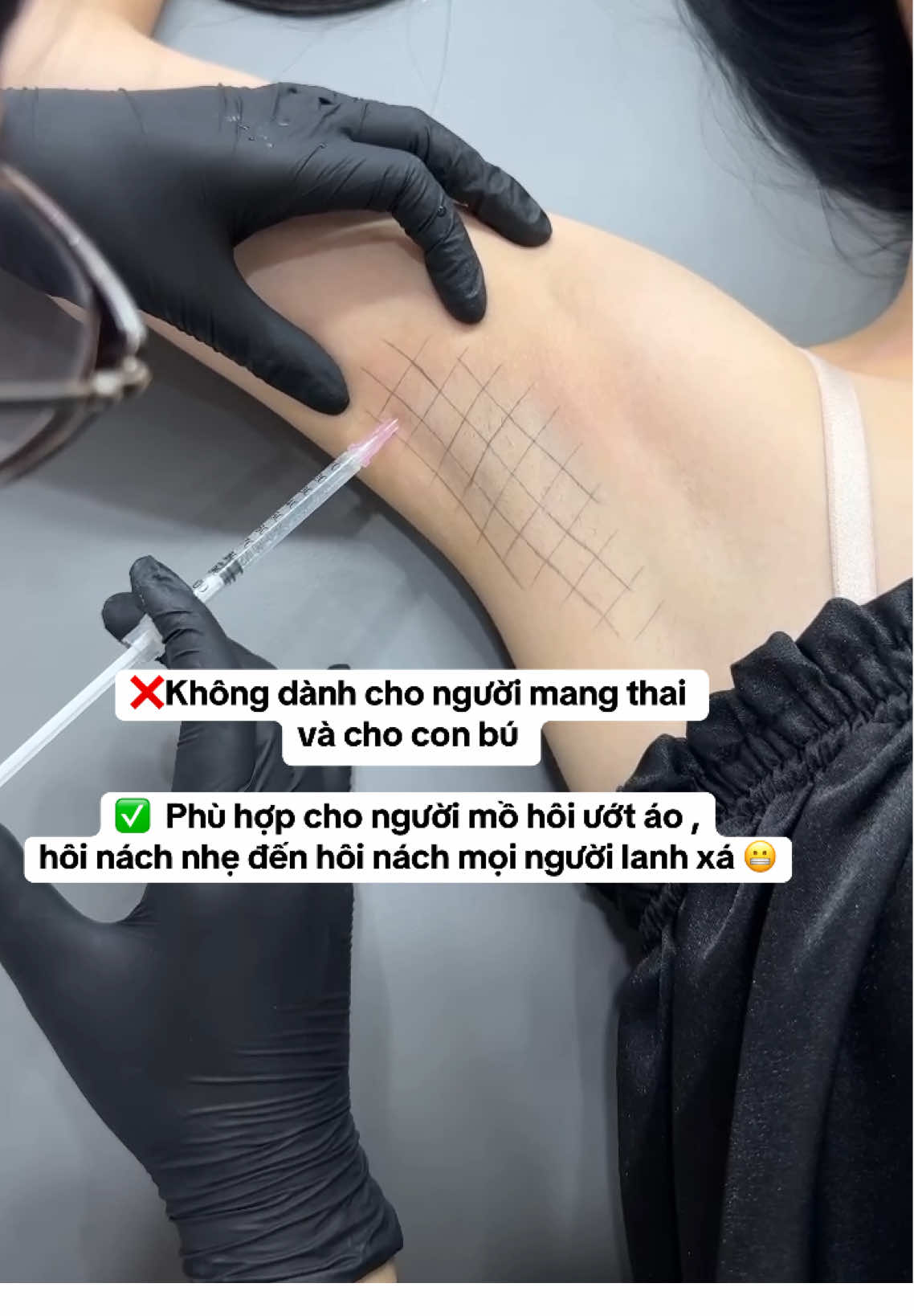 Có thật là chó cắn không đau bằng ngồi sau hôi nách không vậy ??? #tiêm_trị_hôi_nách #botox #khửmùihôinách #xuhuong #fyp #chuẩnhàn #1499 