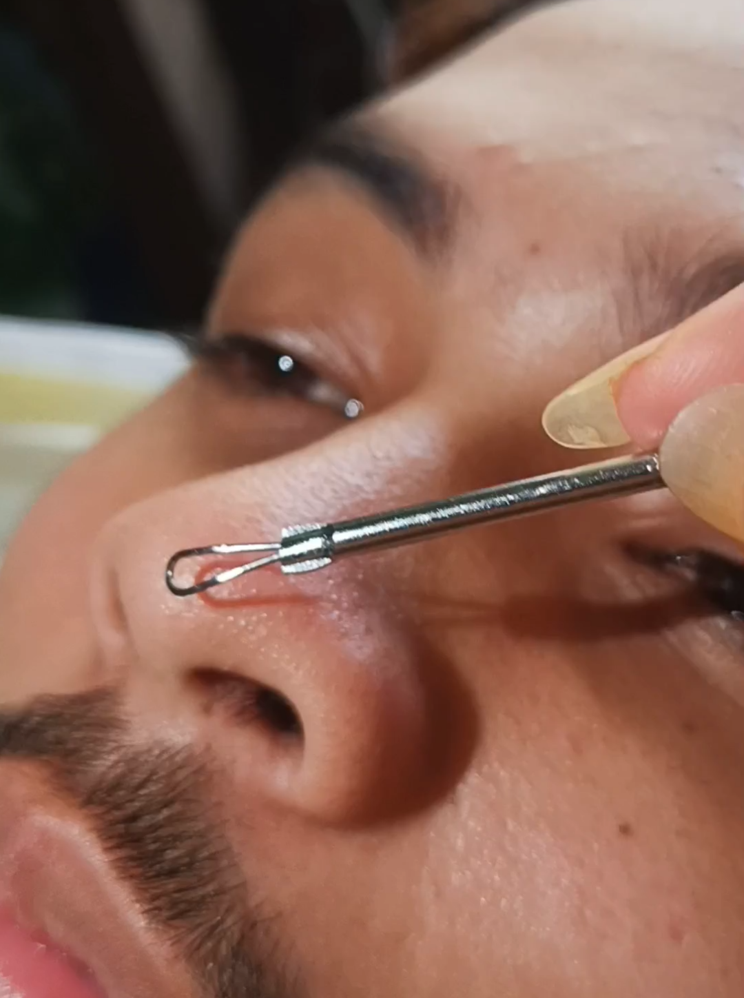 Stainless removal acne kit🥰maspinamura #stainlessremovalacne #acnetreatment #tiktokaffliate 